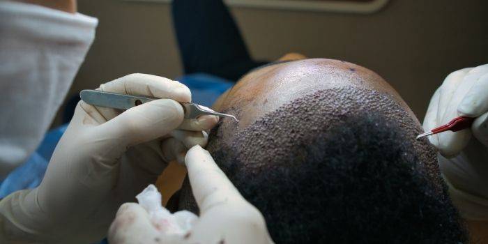 علاجات الشعر غير الجراحية